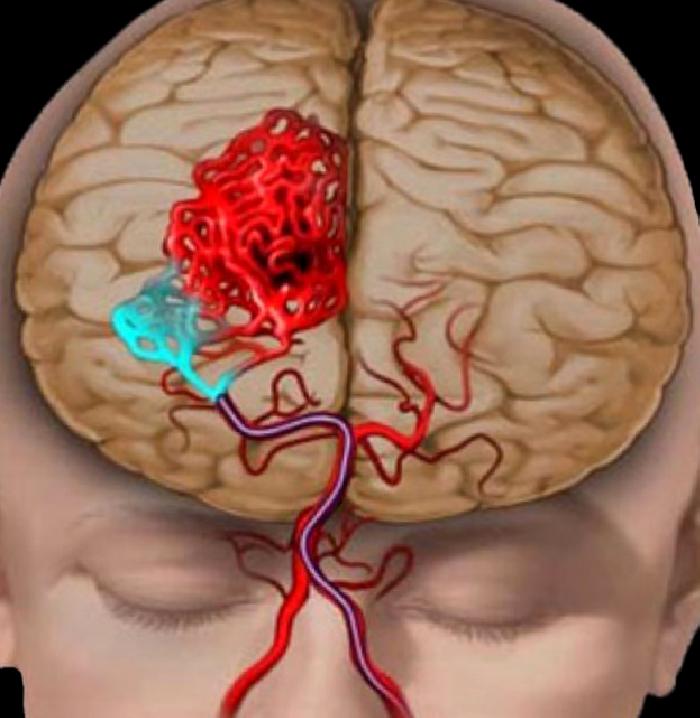 AVM (Arteriovenöz Malformasyon)  Beyinde Damar Yumağı