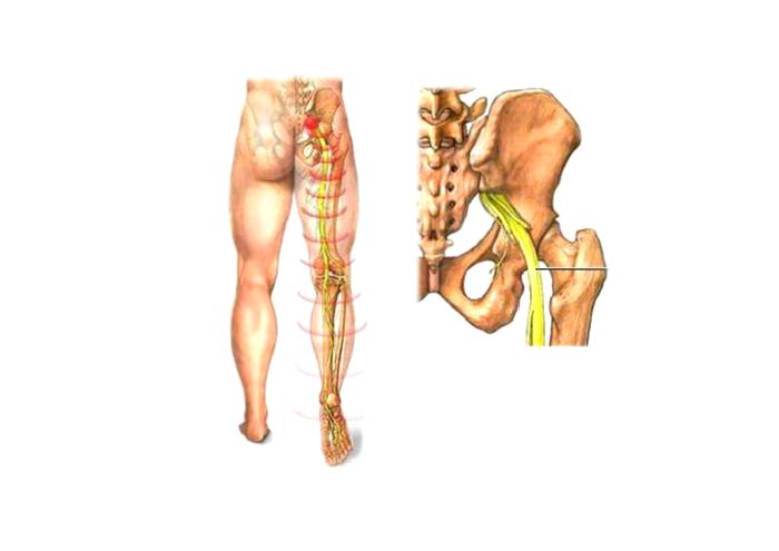 Bacak Uyuşma Nedenleri