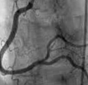 Balon Stent Tedavisi, Bypass Ameliyatı