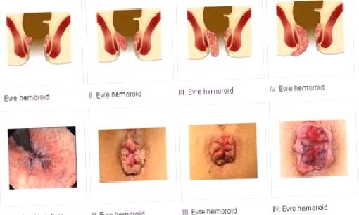 Basur ya da Hemoroid
