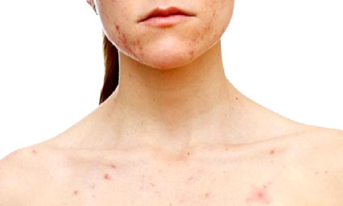 Behçet Hastalığı Nedir?