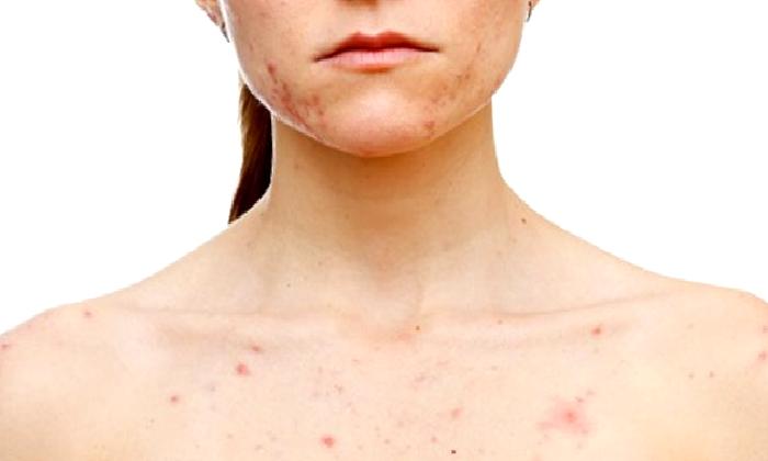 Behçet Hastalığı