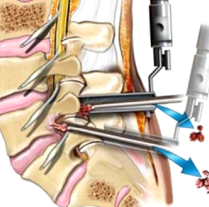 Belde Kanal Darlığı (Blomber Spinal Stenoz)