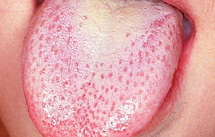 BETA mikrobu,şimdi de KIZIL yapıyor