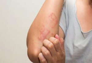 Bilinçsiz İlaç Kullanımı Deri Döküntüsüne Neden Oluyor