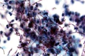 BİYOPSİ NEDİR? CERRAHİDE BİYOPSİ YÖNTEMLERİ NELERDİR?