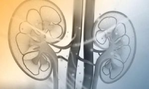 Böbrek Çıkışı Darlığı (Üretero-pelvik Bileşke darlığı-UP Darlık)