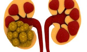 Böbreklerinizi Taşlardan Arındırın