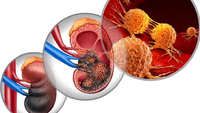 Böbreküstü Bezi Hastalıkları ve Tümörleri-Adrenal Tümör Nedir?