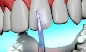 Bonding – Adeziv Diş Hekimliği