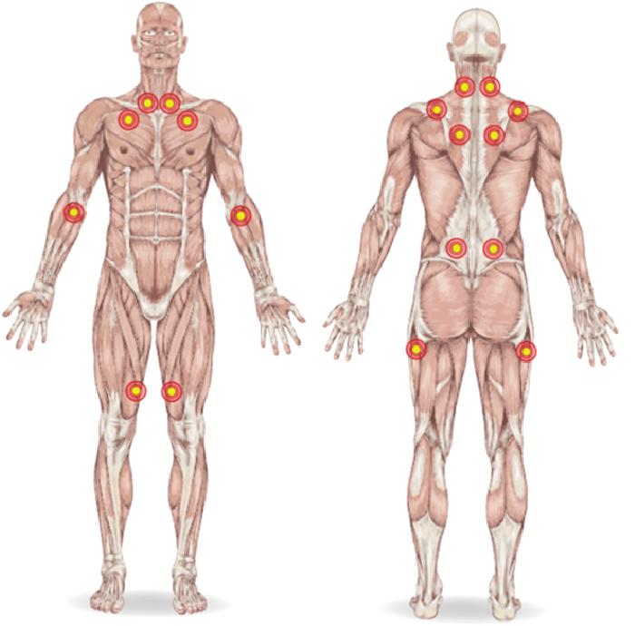 Brakiyal Pleksus Yaralanması ve Fizyoterapisi