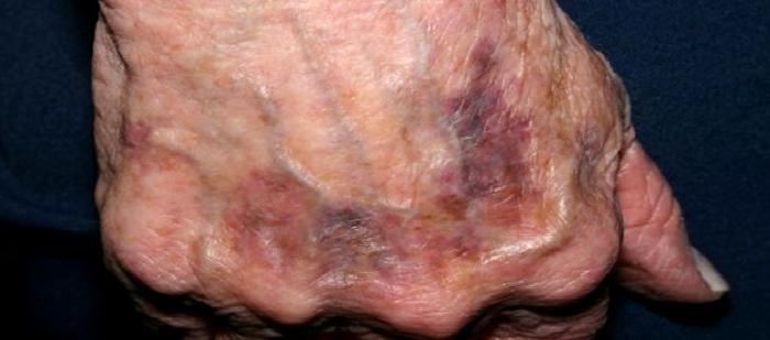 Cildimde Morarmalar Oluyor; Önemli Mi?