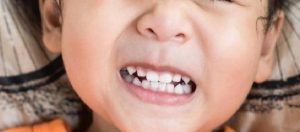 Çocuklarda Koruyucu Dolgu