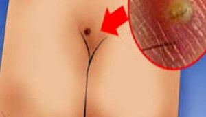 Çocuklarda Pilonidal sinüs hastalığı (Kıl dönmesi):