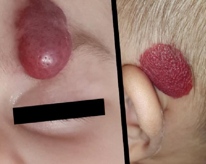 Çocukluk Çağında Hemanjiyomlar