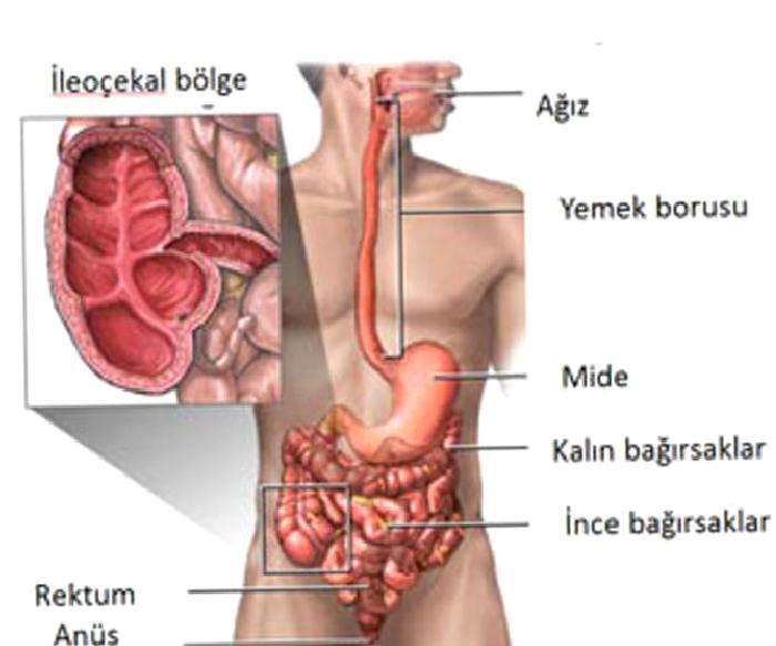 Crohn Hastalığı