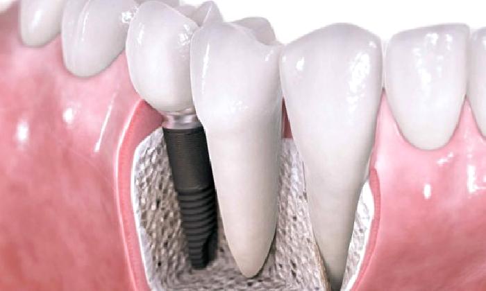 Dental İmplant Cerrahisi Uygulamalarinda Antibiyotik Kullanimi Gerekli midir? (2015 Konsensus Raporu)