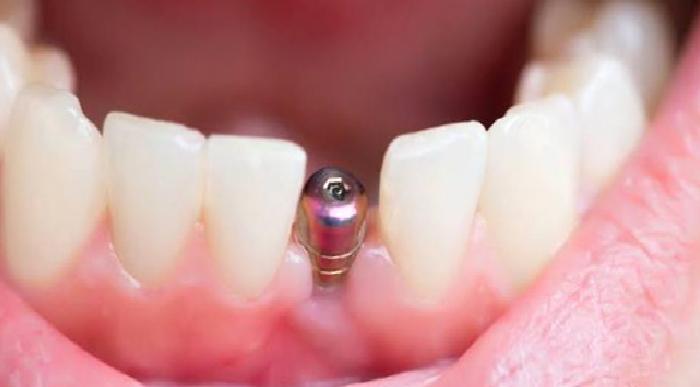 Dental İmplant Tedavisi