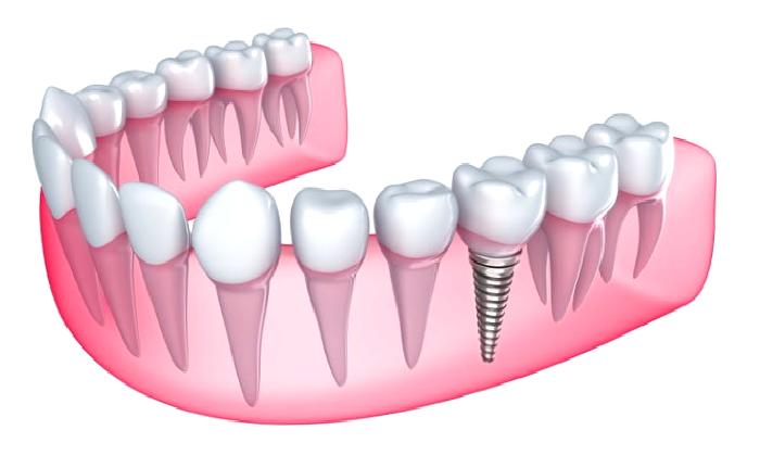 Dental İmplantlar