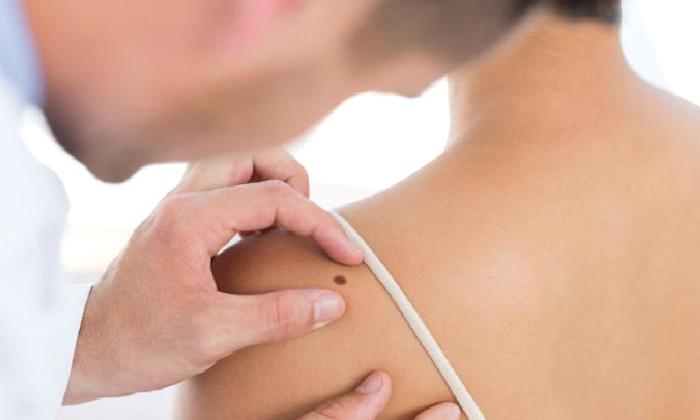 Deri Kanseri Gelişmesinde Güneş Işınlarının Rolü