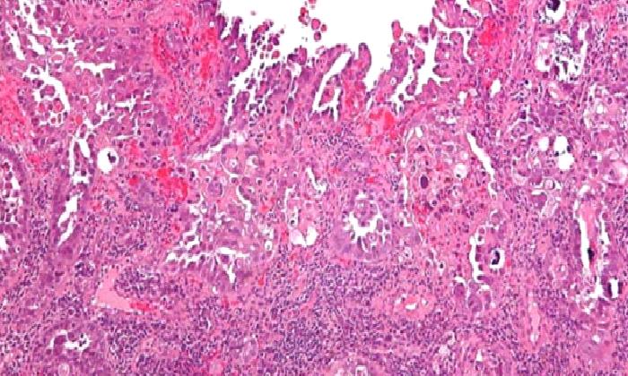 Deri Kanserleri ve Tedavileri