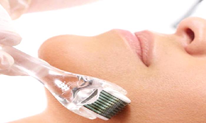 Dermapen – Dermaroller