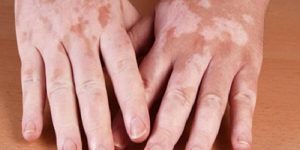 Dermatolojide Hastalıklar