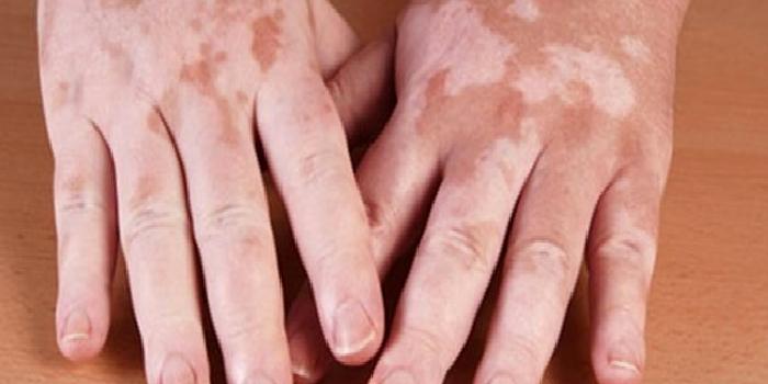 Dermatolojide Hastalıklar