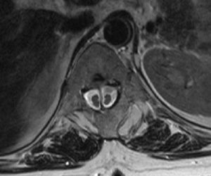 Diastematomyeli, Tethered Cord ve Gergin Omurilik Sendromu Nedir? Meningosel ne Demektir?