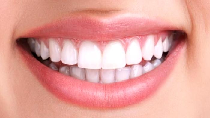 Diş Beyazlatma