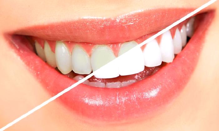 Diş Beyazlatma (Bleaching)