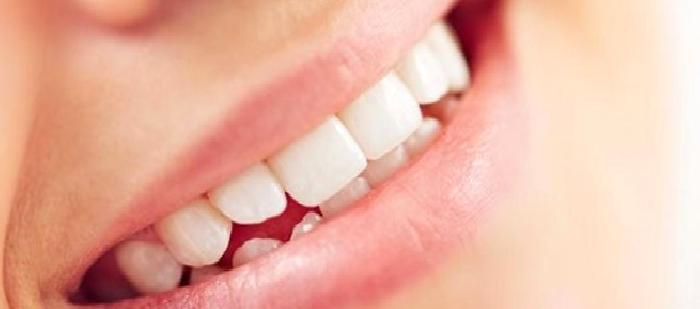 Diş Beyazlatma (Bleaching)