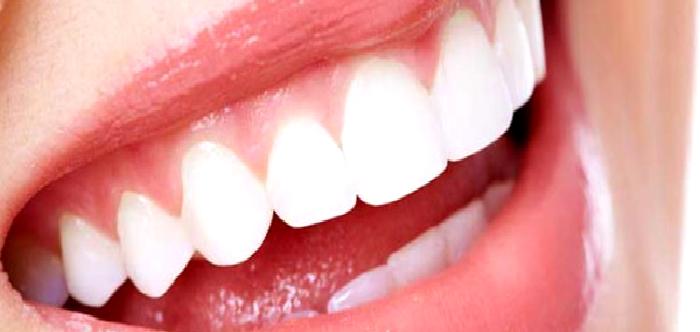 Diş Beyazlatma (Bleaching)