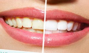 Diş Beyazlatma Hakkında Sıkça Sorulan Sorular