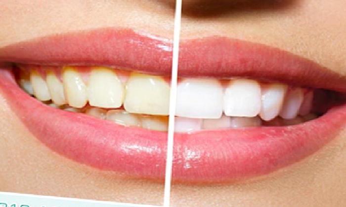 Diş Beyazlatma Hakkında Sıkça Sorulan Sorular