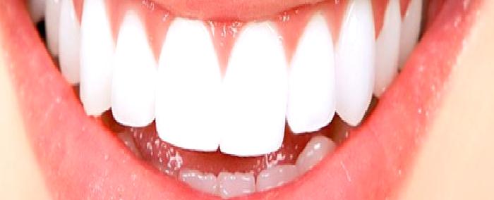 DİŞ BEYAZLATMA HAKKINDA SIKÇA SORULAN SORULAR
