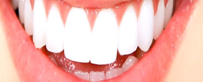 Diş Beyazlatma/Ağartma İşlemi