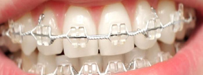 Diş Estetiği Tedavisi