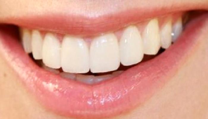 Diş Eti Çekilmeleri Nedir? Periodontoloji Nedir? Diş Eti Ameliyatları Nasıl Yapılır, Küretaj Tedavisinin Faydası Nedir Ve Nasıl Yapılır?