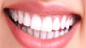 Diş Eti Estetiği
