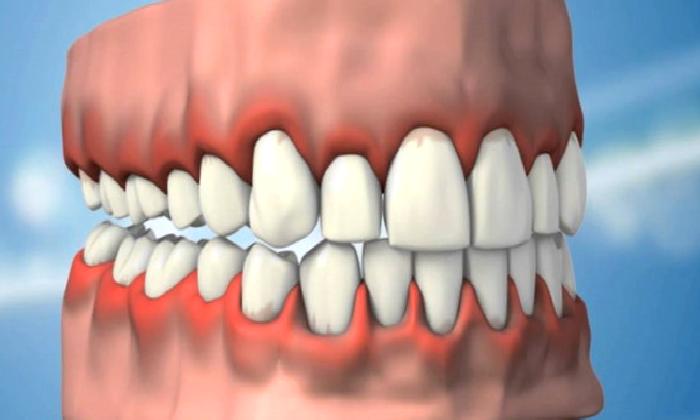 Diş Eti hastalıkları  nelerdir? Diş Eti Çekilmesi nasıl olur?