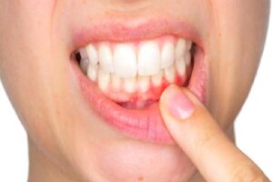 Diş Eti Hastalıkları