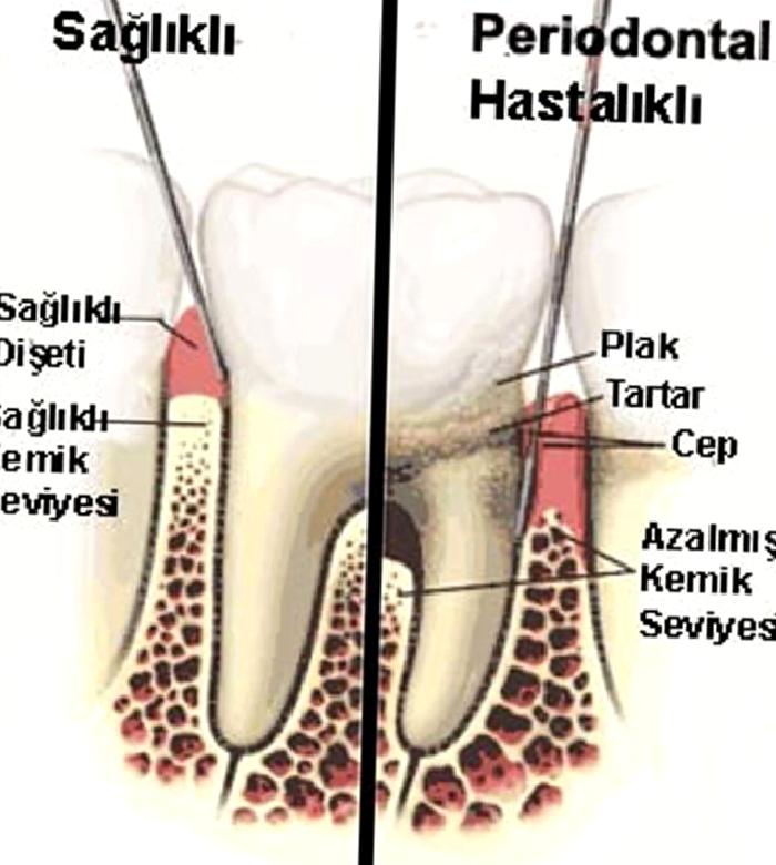 DİŞ ETİ HASTALIKLARINDA BESLENME