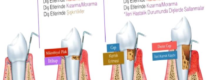 Diş Eti Kanamaları: Buzdağının Görünen Yüzü