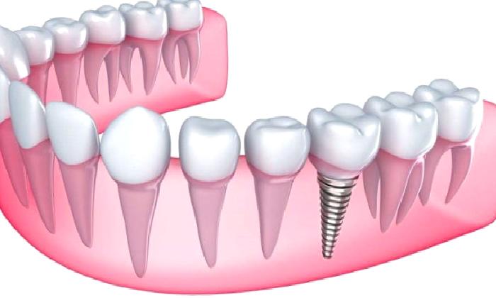 DİŞ İMPLANT SİSTEMİ