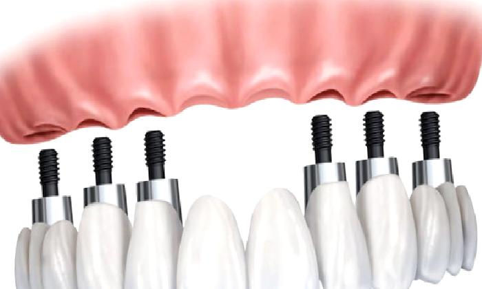 Diş implantı nedir? Diş implantının riski varmıdır?