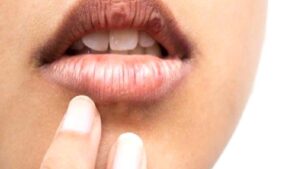 Diş Sıkma Problemine “Masseter Botoksu”
