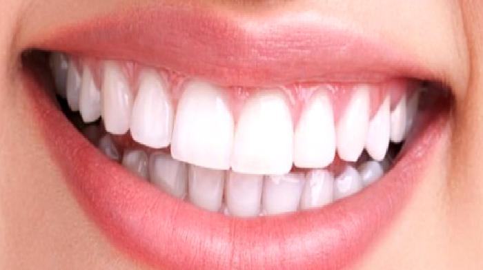 Diş Taşı Temizliği (Detertraj) Nedir?