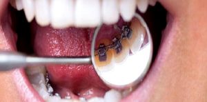 Diş Tel Tedavisinde Ağız Bakımı