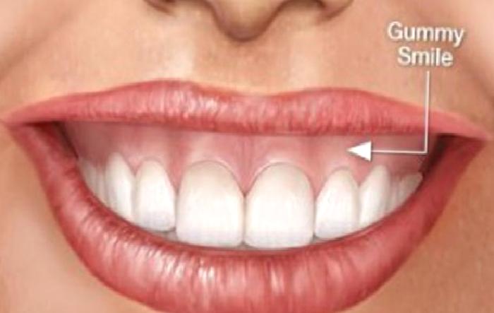 DİŞETİ ESTETİĞİ NEDİR (GUMMY SMİLE-DİŞETİ GÜLÜŞÜ) NASIL TEDAVİ EDİLİR ?